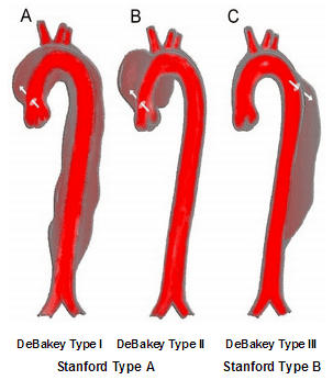 aorticdissectionclassification1