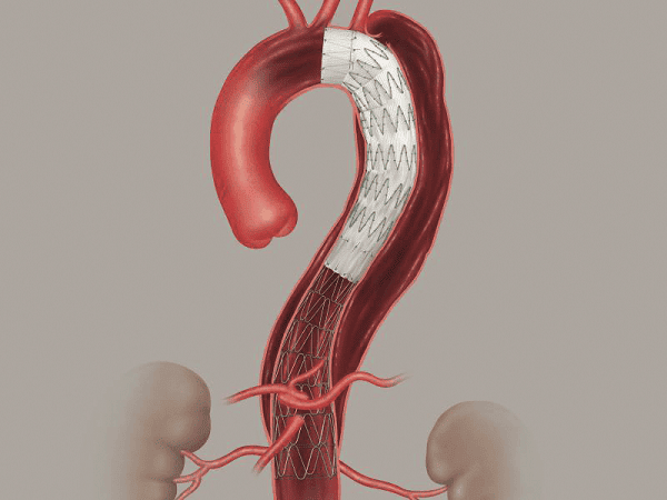 Cook-dissection-graft