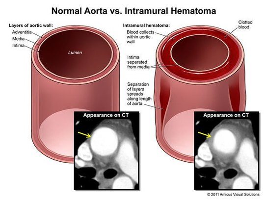 Hematoma_web1