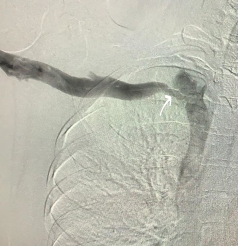 Inkedvenöz t. outletsen s