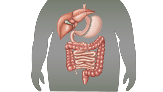 Sleeve-Gastrectomy