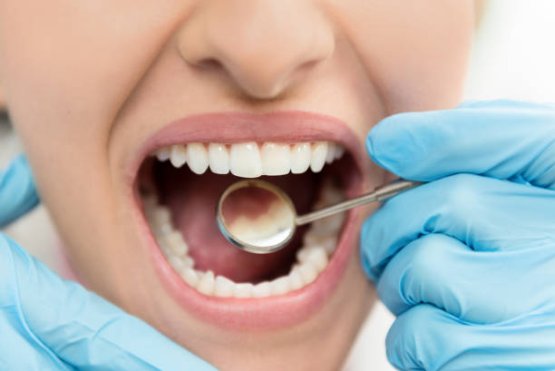 How to treat eroded tooth enamel? - Dentist Funda Özen