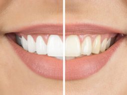 Things to Consider After Teeth Whitening - Dentist Funda Özen