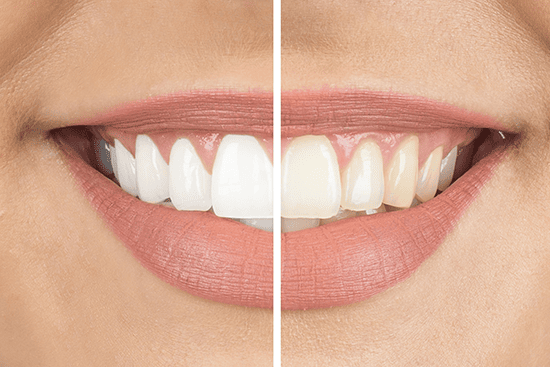 Teeth Whitening Treatment
