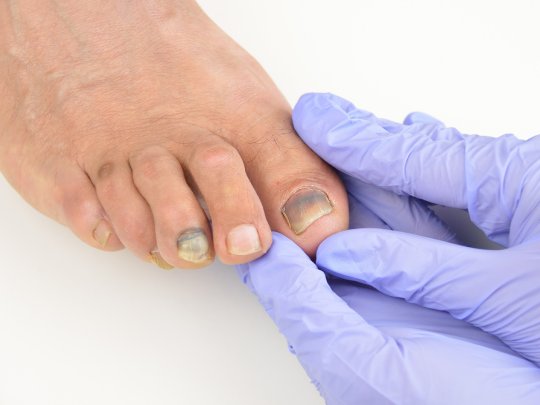 Tırnakta Renk Değişikliği