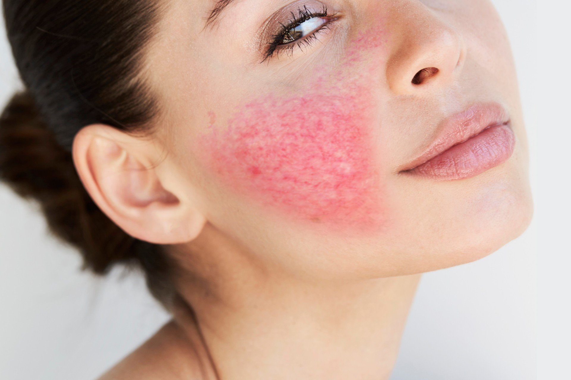 Gül Hastalığı Roza