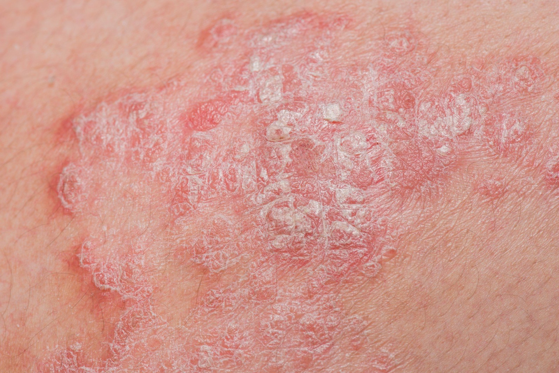 Sedef Hastalığı (Psoriasis)