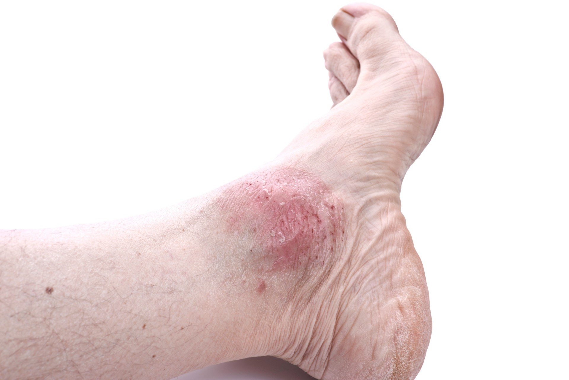 Deride İltihaplanma