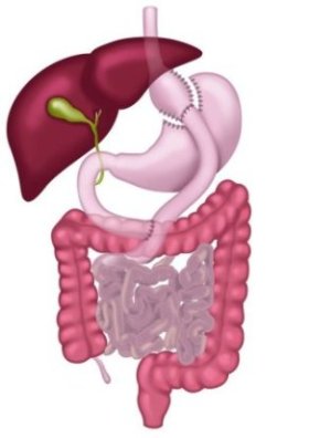 gastrik-bypass-1