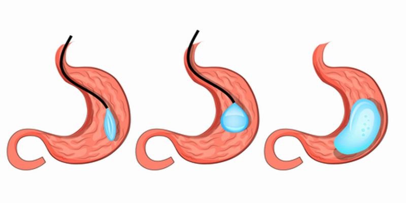 Gastric Balloon in Turkey - Weight Loss