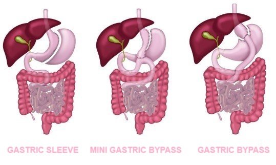 Obesity-Surgery-Turkey