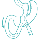 Mini Gastric Bypass in Turkey