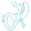 Mini Gastric Bypass in Turkey