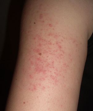 keratosis_pilaris