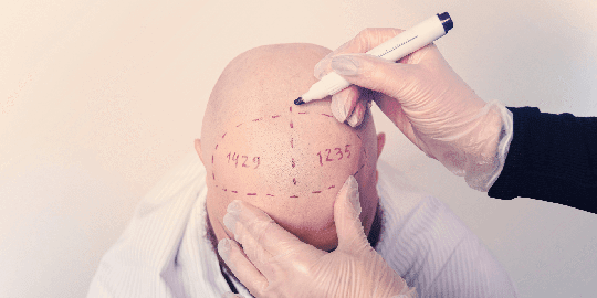 Saç Ekimi Merkezinin Yasal Olduğunu Nasıl Anlarsınız?