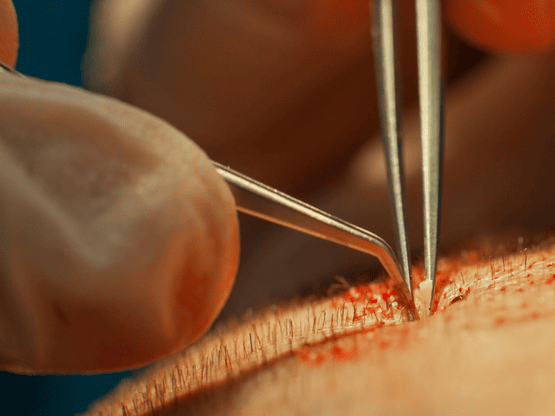 Can Your Body Reject A Hair Transplant?