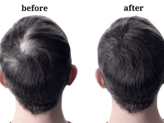 First three months after hair a hair transplant