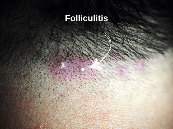 folliculitis