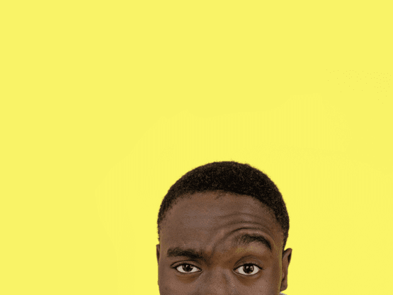 Why 5000 Grafts Are Rarely Achievable in Hair Transplants