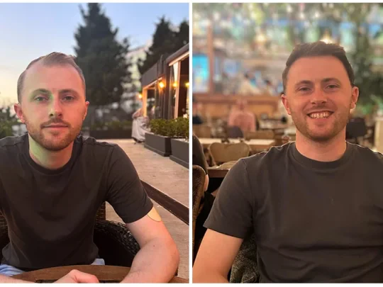 Patient Interview: James’s Hair Transplant Review in Turkey at DK Klinik