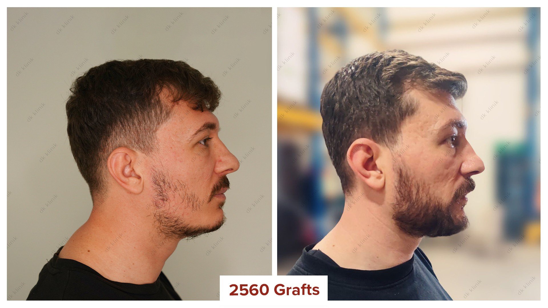beard_transplant_before_after_2