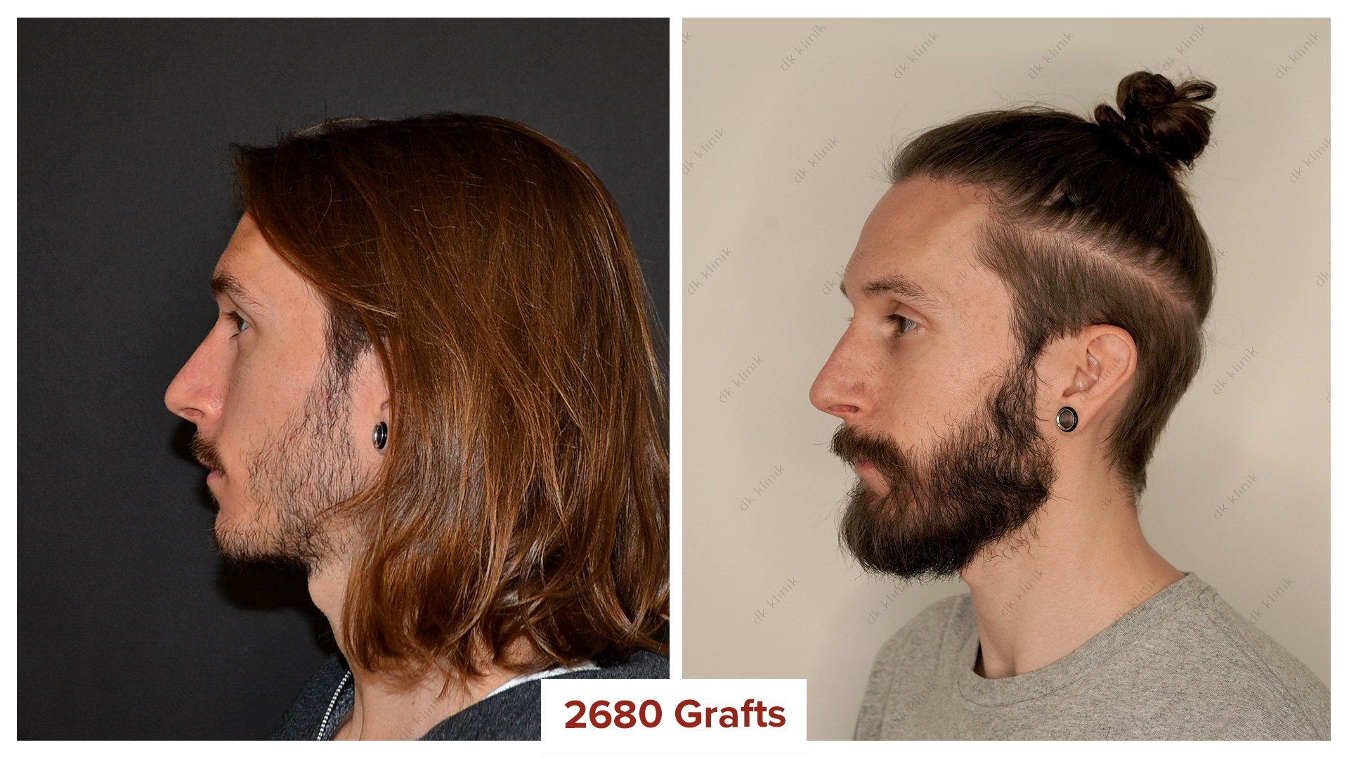 beard_transplant_before_after_1