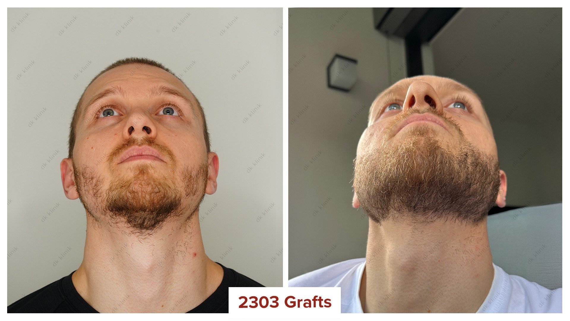 beard_transplant_before_after_3