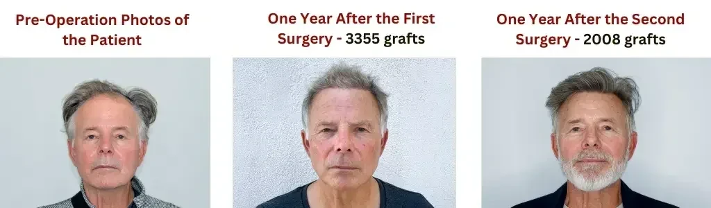 Will I need a second hair transplant?