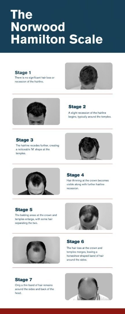 How many grafts do I need?