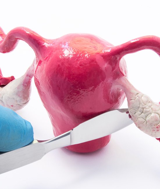 Ovarian Cyst Treatment