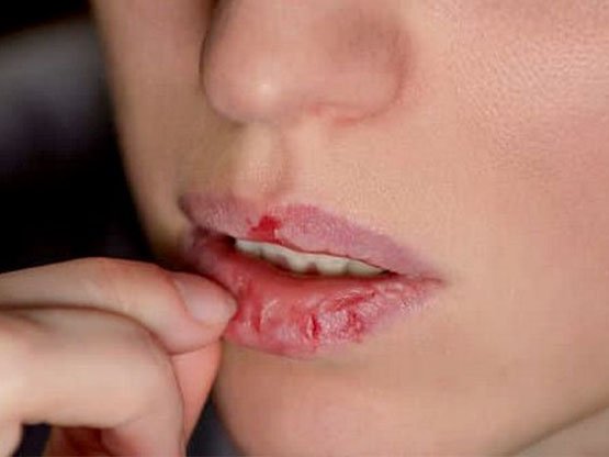 Kış aylarında dudak çatlaması ve bakımı