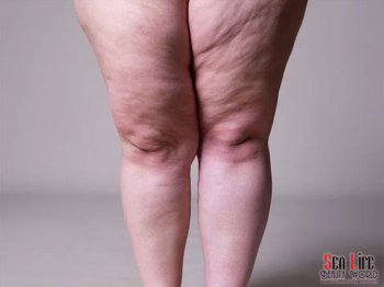 Lipödem Rahatsızlıklarında Ankara Lenf Drenaj Masajı