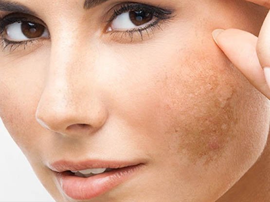 Cilt Lekesi bakımı 3 yan