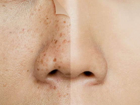 Cilt Lekesi bakımı 4 yan