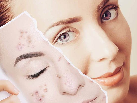 Cilt Lekesi bakımı 6 yan