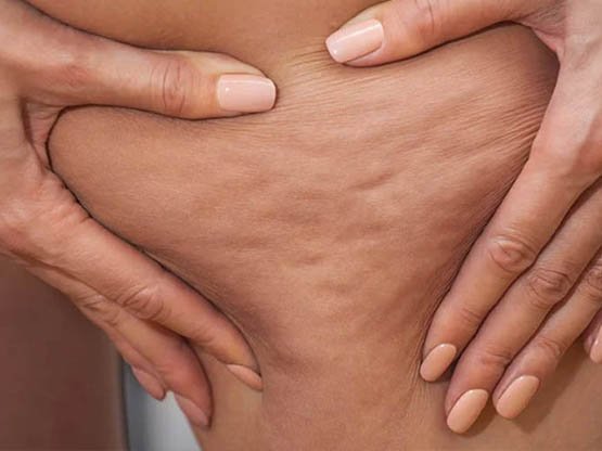 Selülit Tedavisi Ankara Madero Terapi Masaj