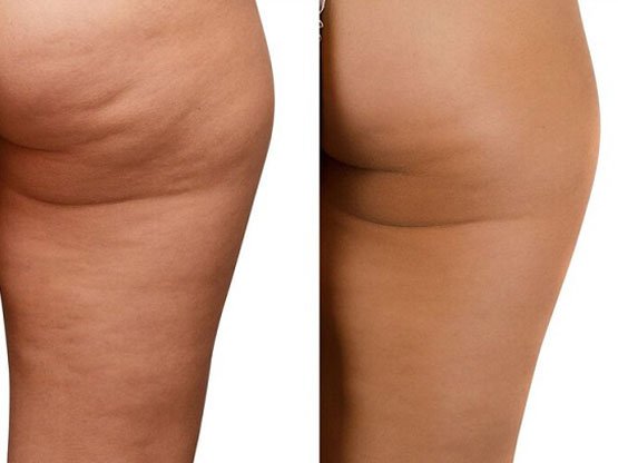 Ankara Selülit tedavisi