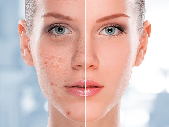 Ankara Cilt Lekesi Bakımı