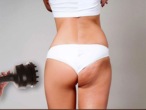 G5 Masaj Selülit Tedavisi