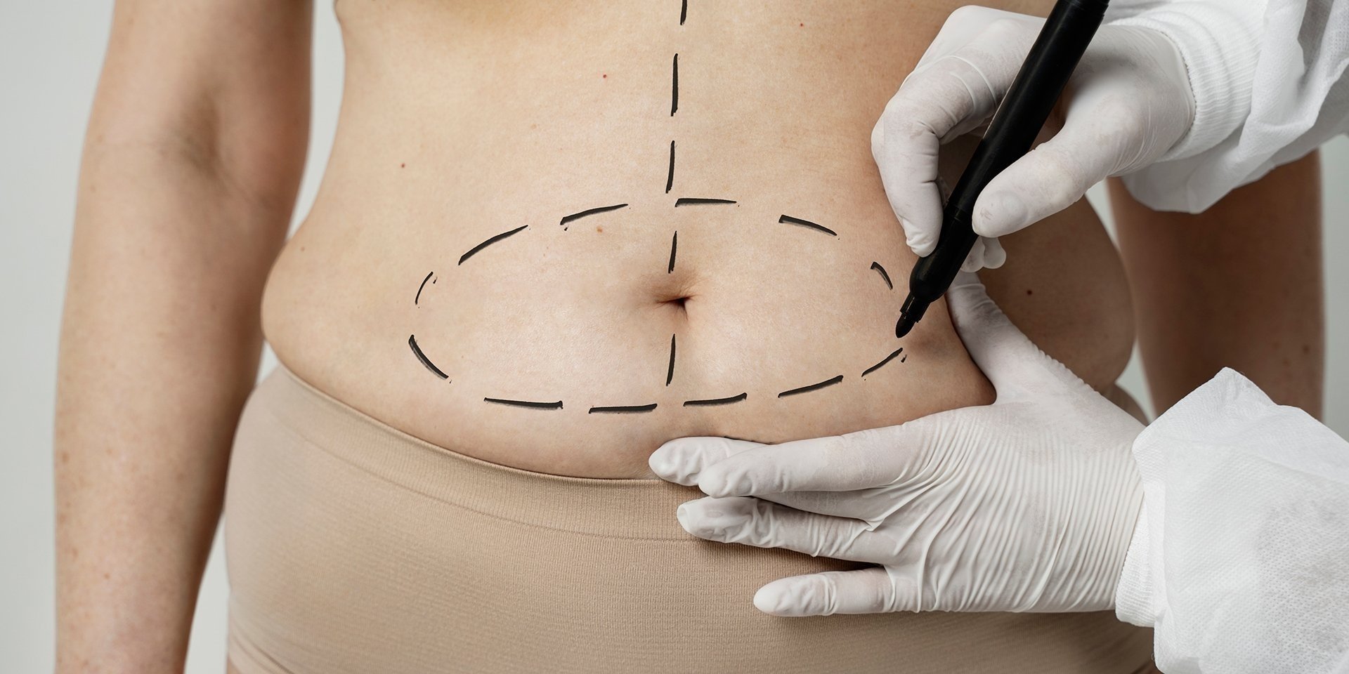 Woman with markings on her abdomen for liposuction or tummy tuck, showing the extent of plastic surgery.