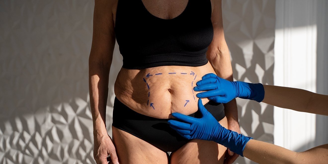 A surgeon makes markings on the abdomen of a woman with abdominal sagging before mommy makeover surgery.