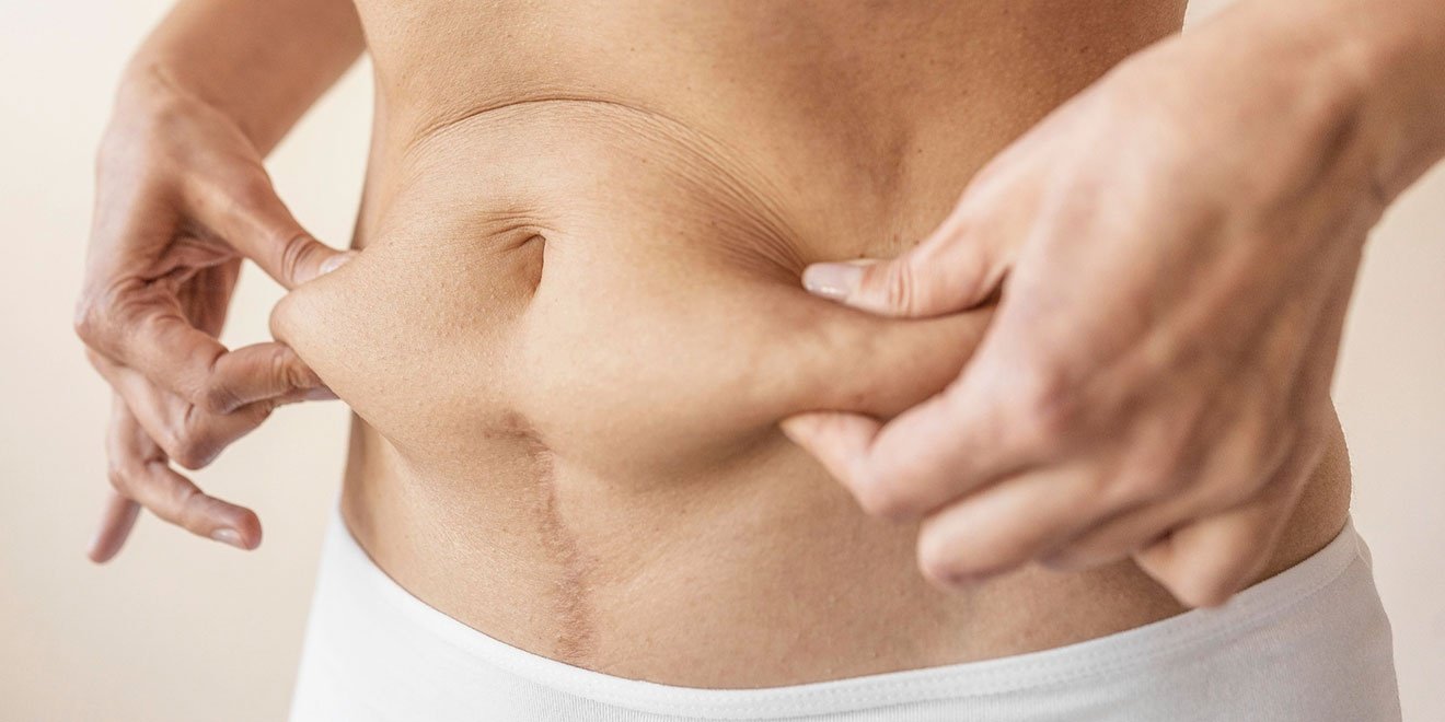 Woman holding sagging abdominal skin, indicating the need for liposuction or tummy tuck