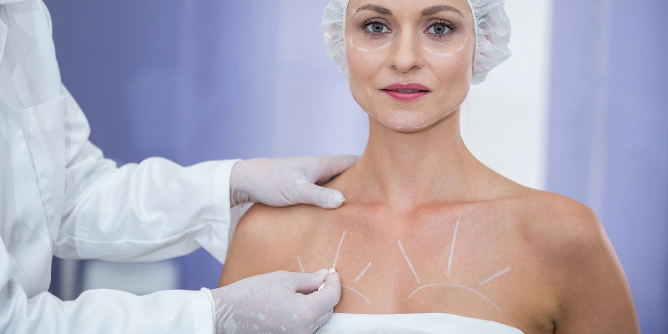 Doctor making planning marks on a patient's breast during a breast augmentation consultation, deciding between submuscular, subglandular, or dual plane.