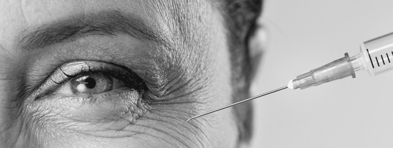 Close-up of Botox injection for crow's feet wrinkles around the eye to achieve a youthful gaze.