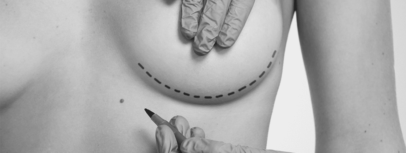 Woman's breast with surgical markings and hands in gloves, illustrating pre-operative planning for breast augmentation surgery.