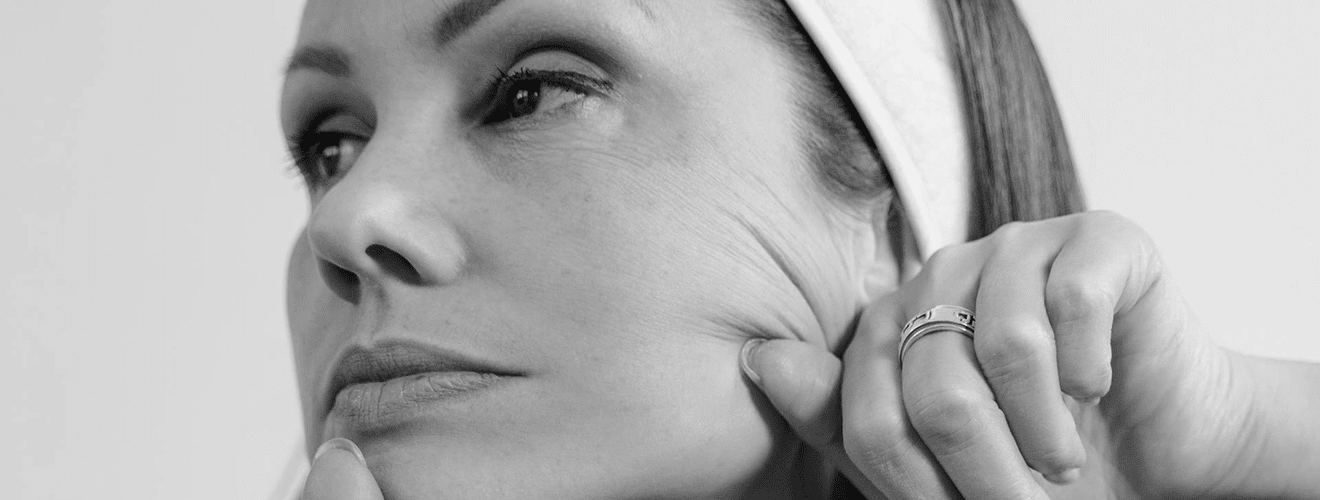 Woman demonstrating facelift surgery effect by lifting sagging cheek skin