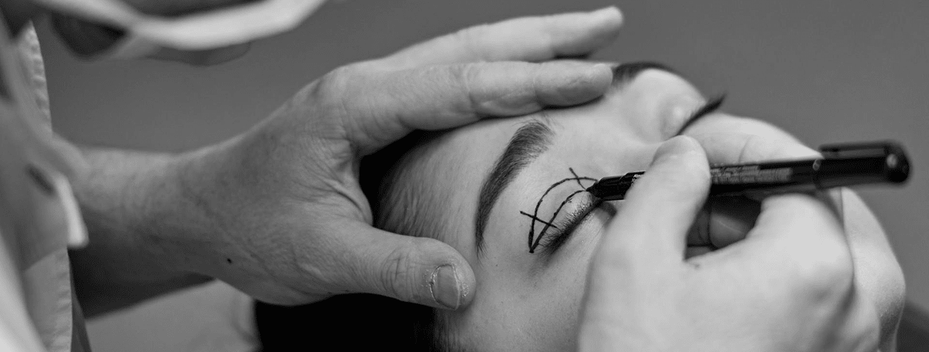 Surgeon's personalized pre-operative markings and planning on the upper eyelid for blepharoplasty (eyelid surgery)