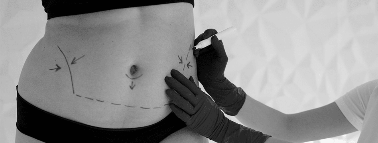 Pre-operative surgical markings on abdomen and flanks for liposuction (fat removal / body contouring) planning.