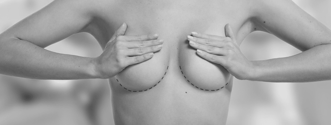 Woman holding breasts with outlines indicating the goal of achieving smaller, aesthetic size with breast reduction surgery.