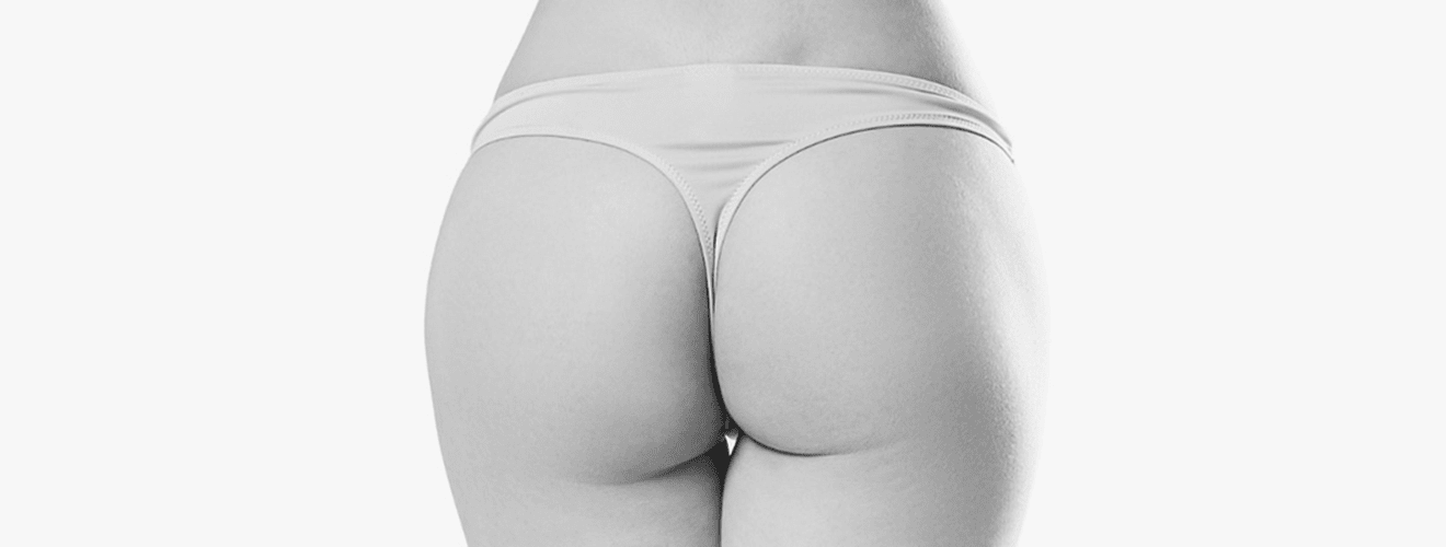 Back view showcasing the full, rounded, and lifted shape achieved with buttock implants (gluteal implants).
